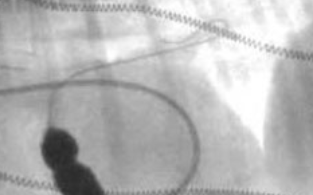 Aortic Balloon Valvuloplasty